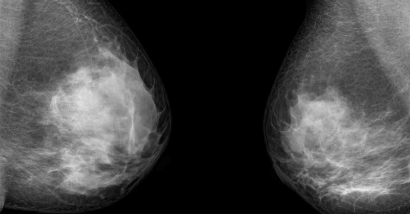mammogram stop FI